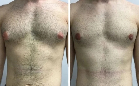 Lifestyle Changes After Gynecomastia Surgery in Dubai