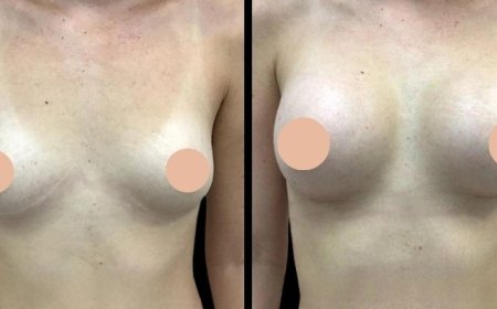 Post-Surgery Support Provided by the Best Breast Augmentation Surgeons in Dubai