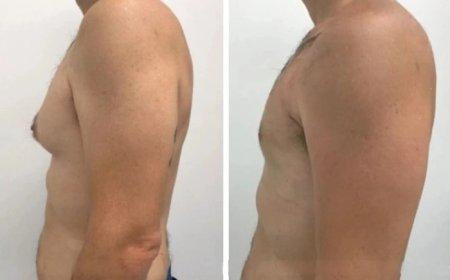 How the Best Gynecomastia Surgeons in dubai Deliver Superior Results for Your Male Boob Surgery