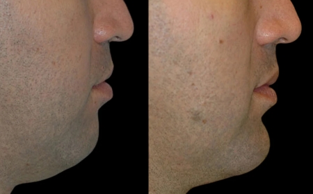 Best Aesthetic Clinic in Dubai for Chin Fillers: Comprehensive Consultation Process