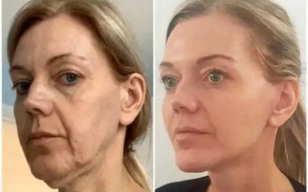 Direct Glow Gains to Best Plastic Surgeons in dubai with Profhilo