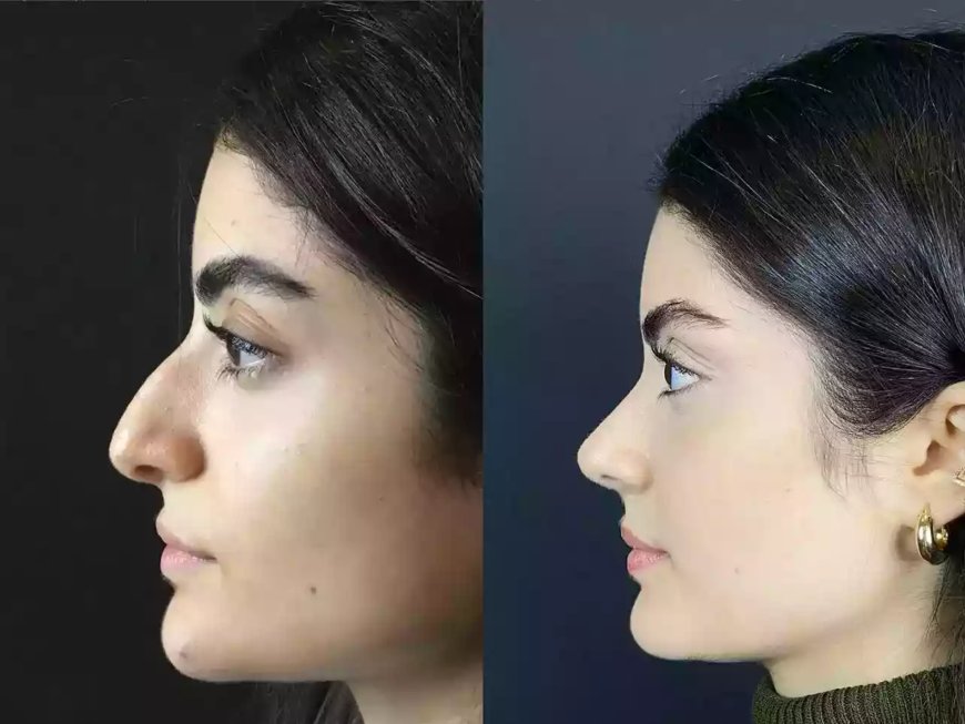Before & After: Transformations by the Best Rhinoplasty Surgeon in Dubai