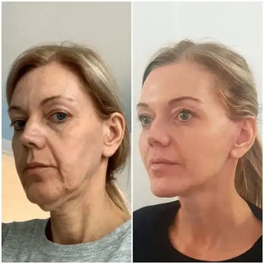 Direct Glow Gains to Best Plastic Surgeons in dubai with Profhilo