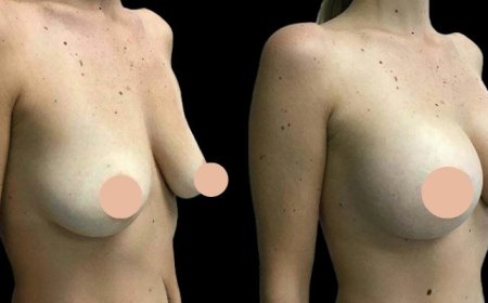 Before and After Breast Augmentation: What the Best Doctors in Dubai Recommend
