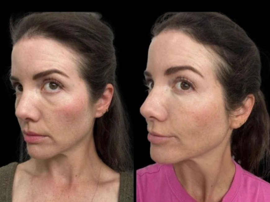 Best Aesthetic Clinics in Dubai for Dark Circles treatment: The Role of Dermal Fillers in Rejuvenation